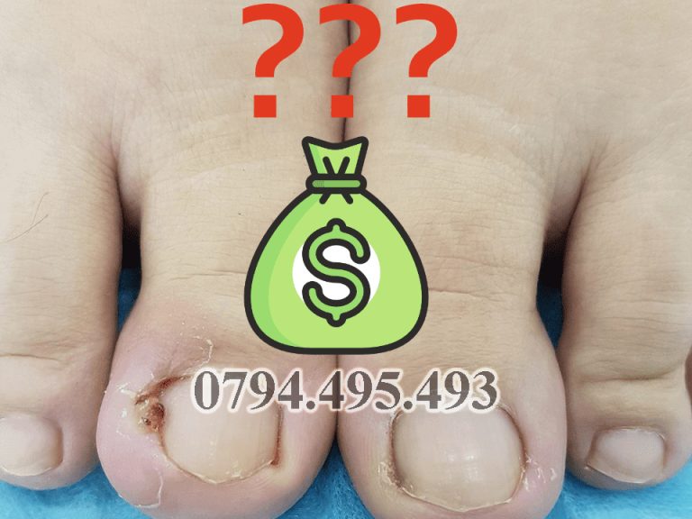 Bảng Giá Tiểu Phẫu Móng Chọc Thịt 2026