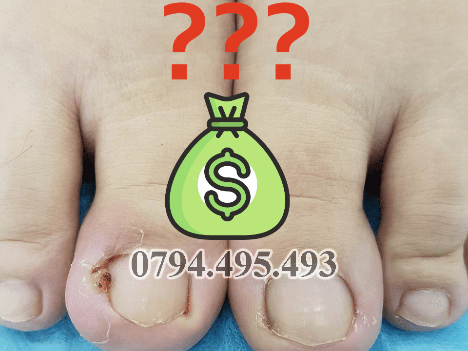 Chi phí tiểu phẫu móng chọc thịt