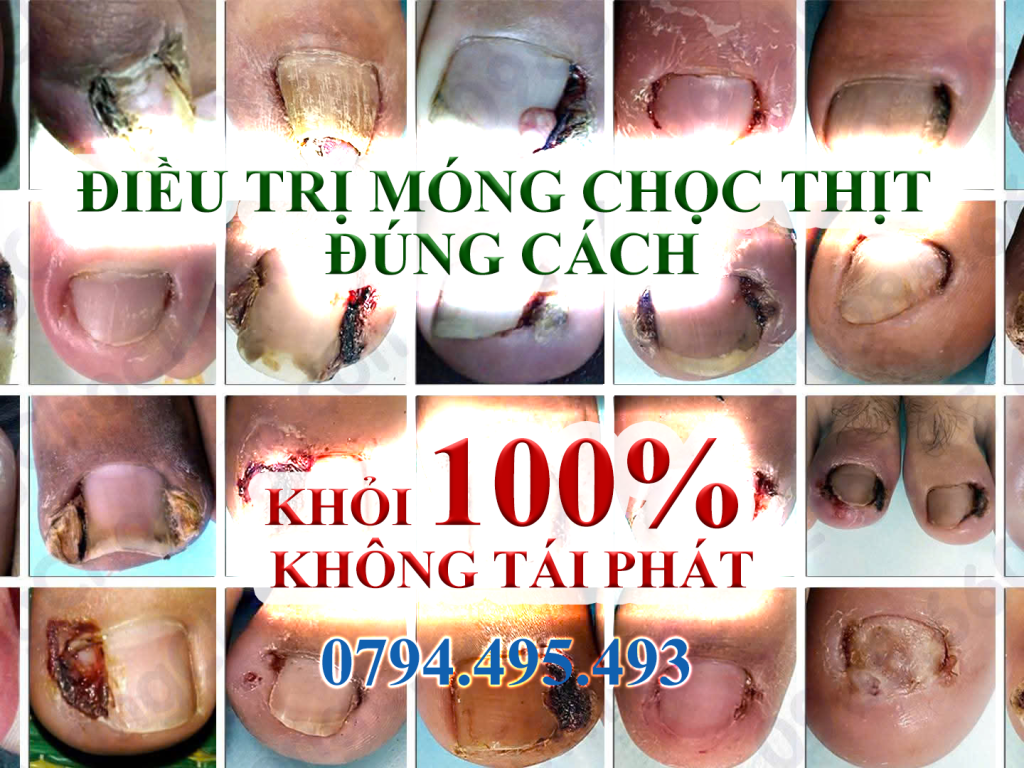 Điều trị móng chọc thịt đúng cách