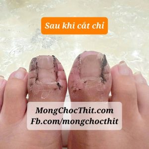 Sau khi cắt chỉ tiểu phẫu móng chọc thịt (thường là 2 tuần)