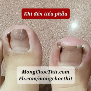 Móng chọc thịt khi đến tiểu phẫu