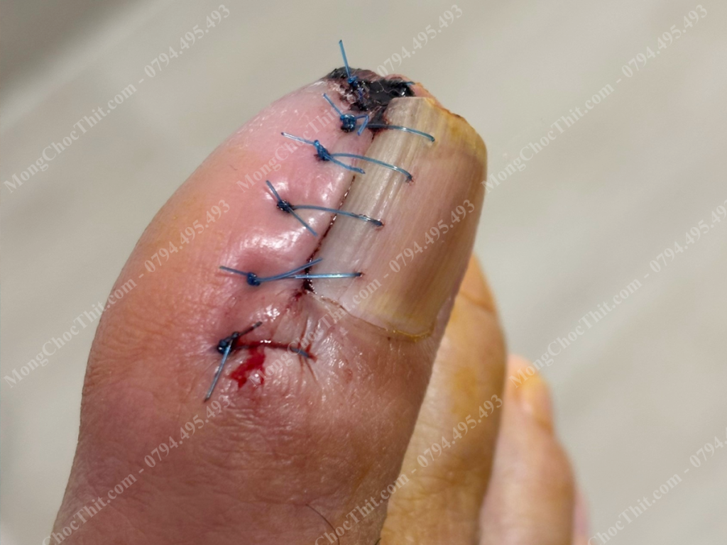 Chăm sóc sau tiểu phẫu móng chọc thịt