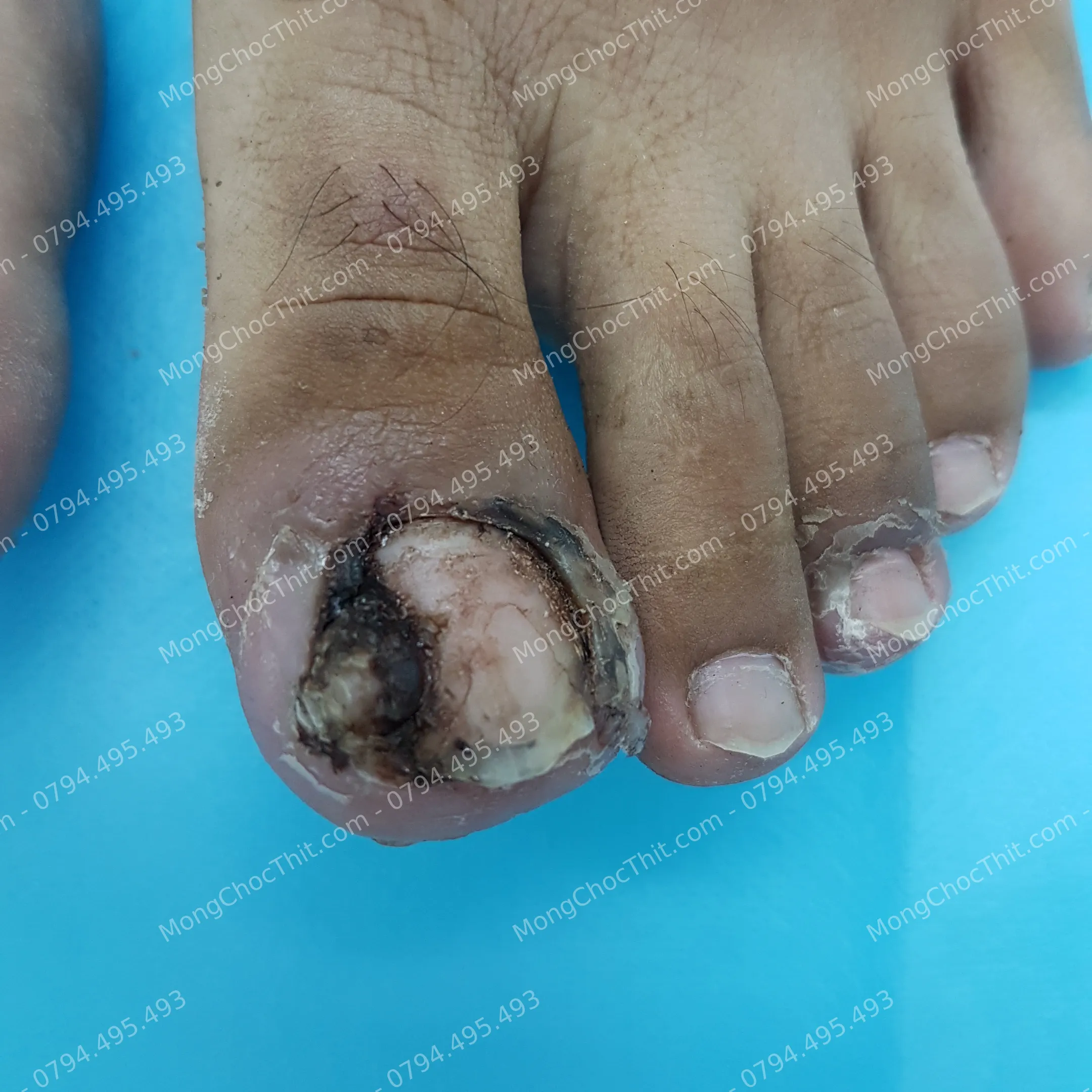 điều trị móng chọc thịt bằng thuốc