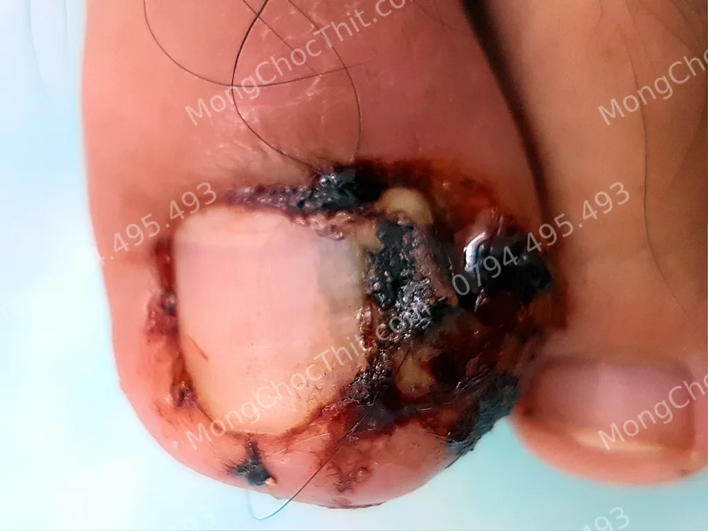 Điều trị móng chọc thịt bằng thuốc chỉ là biện pháp tạm thời