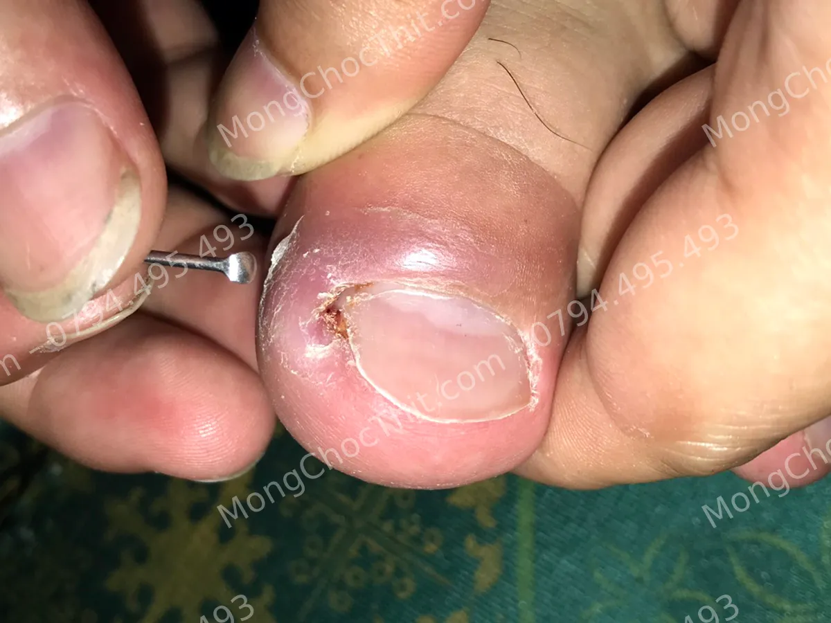 bị sưng đau khóe chân đã lâu bị sưng đau khóe chân đã lâu