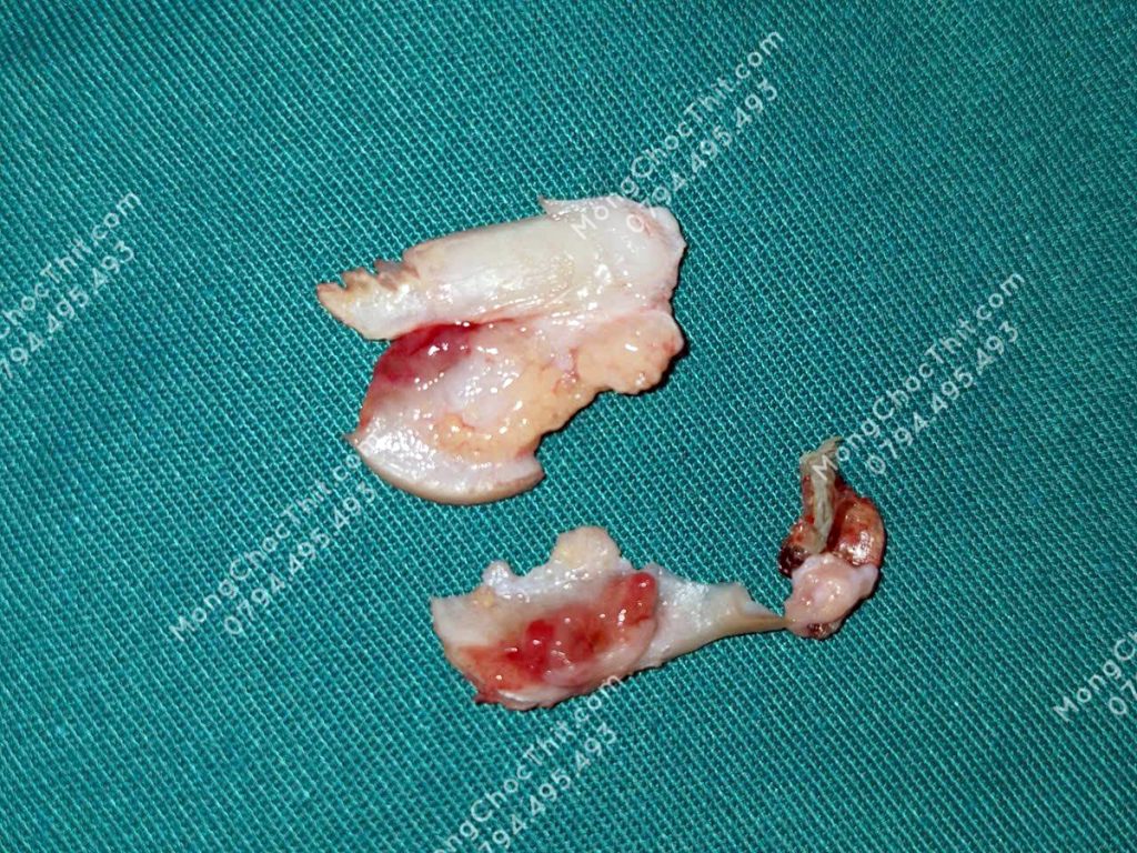 Gốc khóe móng được lấy ra khi tiểu phẫu móng chọc thịt