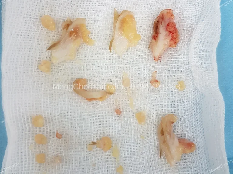 Vết thương tiểu phẫu bị ướt vì mưa hoặc mồ hôi: Xử lý thế nào?