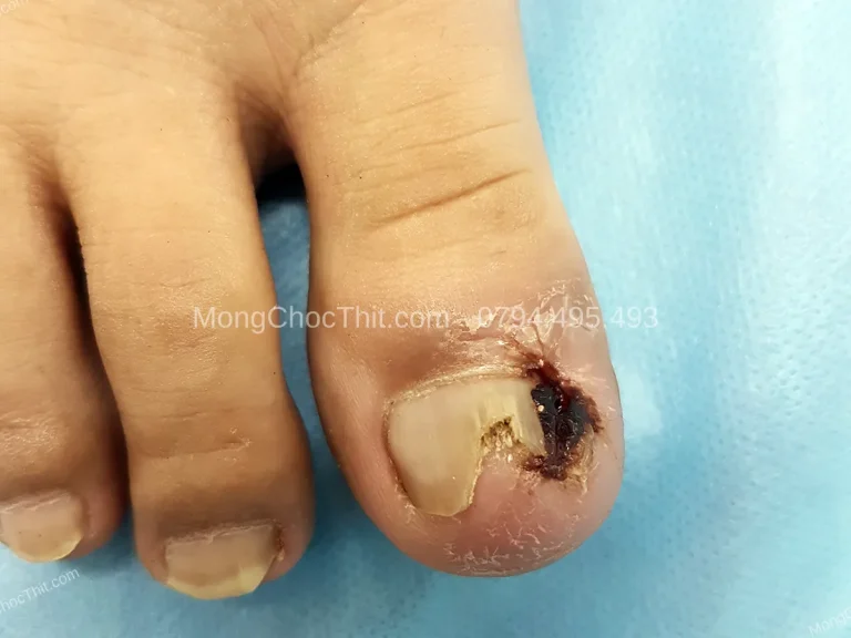 Thuốc giảm đau sau tiểu phẫu móng: Loại nào và liều lượng phù hợp?