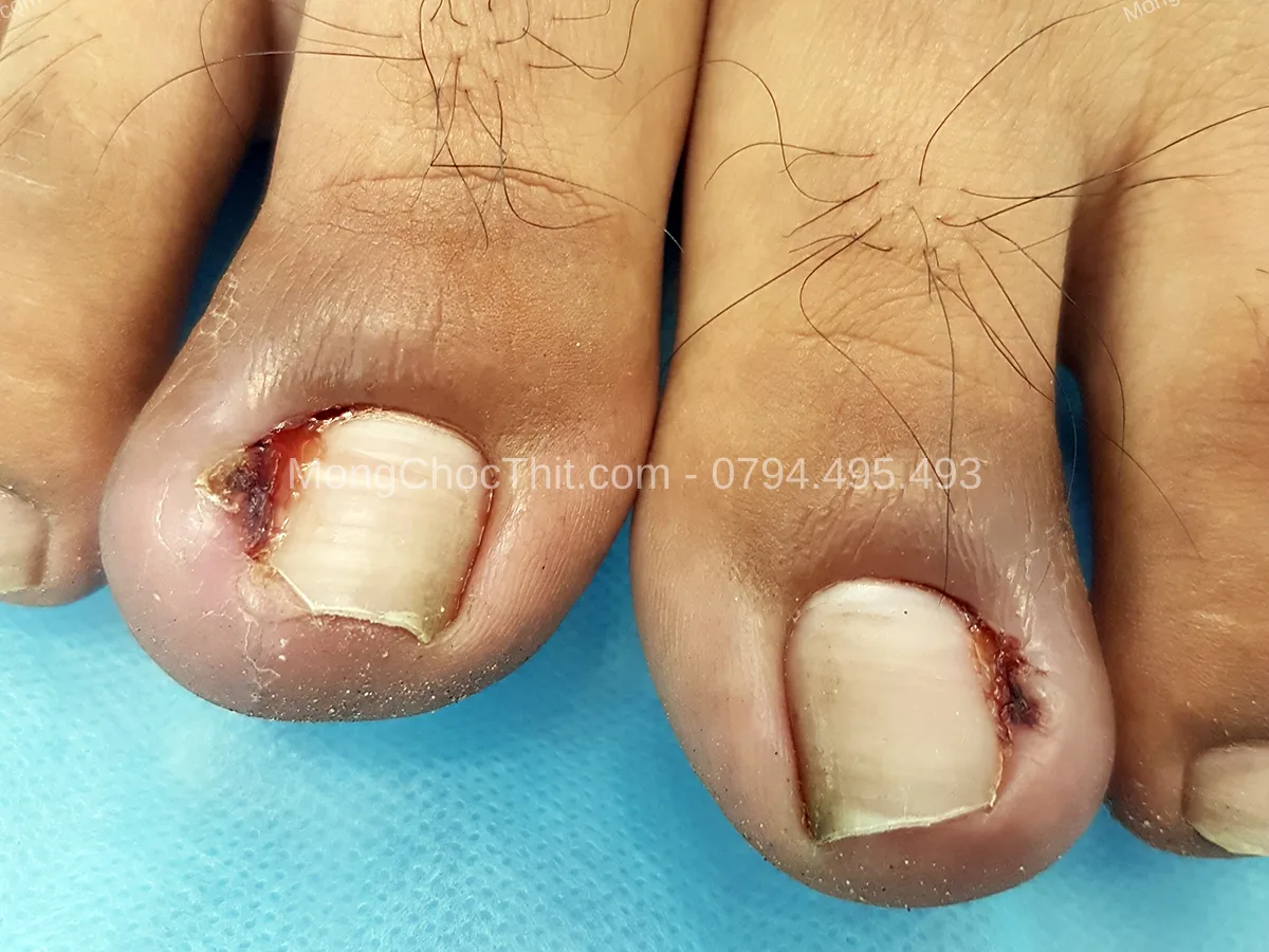 vết thương bị ướt sau mổ