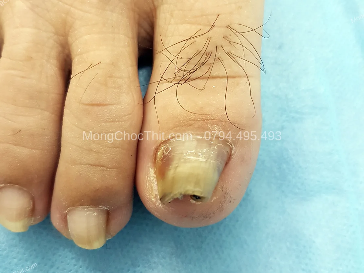 băng b&oacute; sau tiểu phẫu