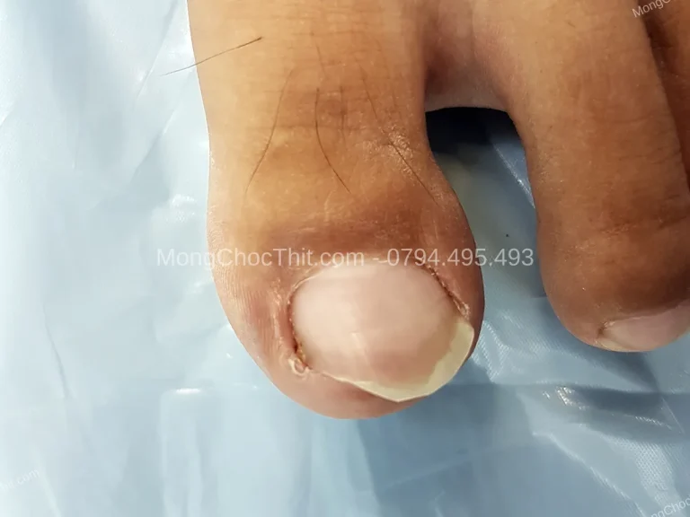 Băng bó vết thương đúng cách sau tiểu phẫu: Không quá chặt, không quá lỏng