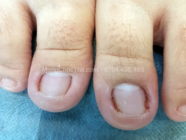 Vệ sinh bàn chân hàng ngày đúng cách để phòng móng chọc thịt