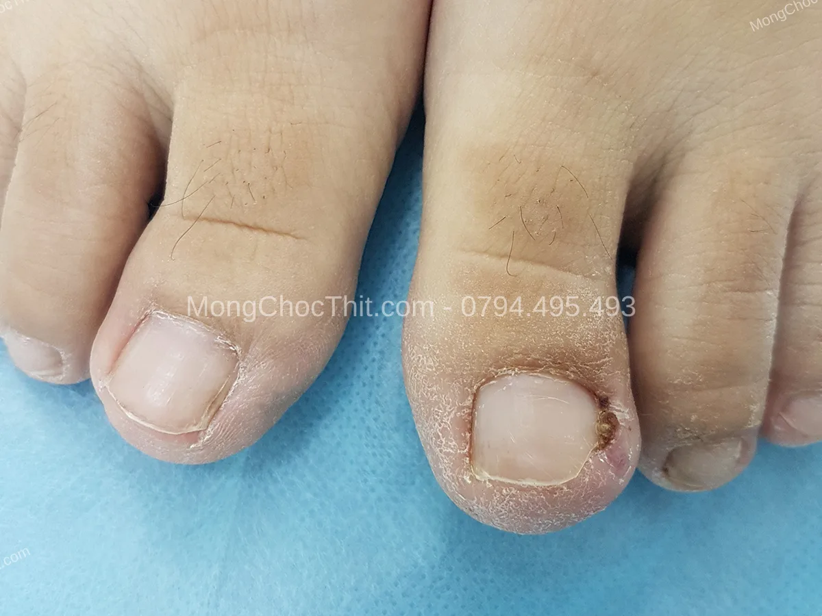 cắt móng sau tiểu phẫu cắt móng sau tiểu phẫu