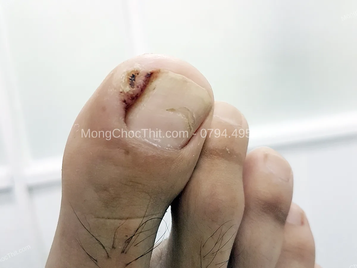 chọn gi&agrave;y ph&ograve;ng m&oacute;ng chọc thịt