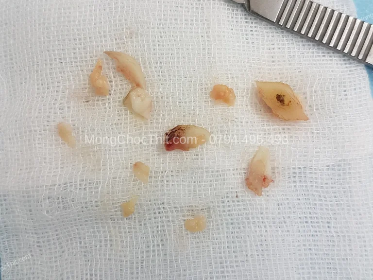 7 thói quen ngăn móng quặm tái phát sau điều trị dứt điểm
