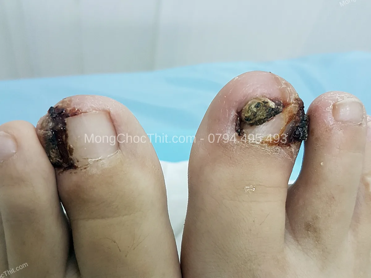 th&oacute;i quen ph&ograve;ng ngừa t&aacute;i ph&aacute;t