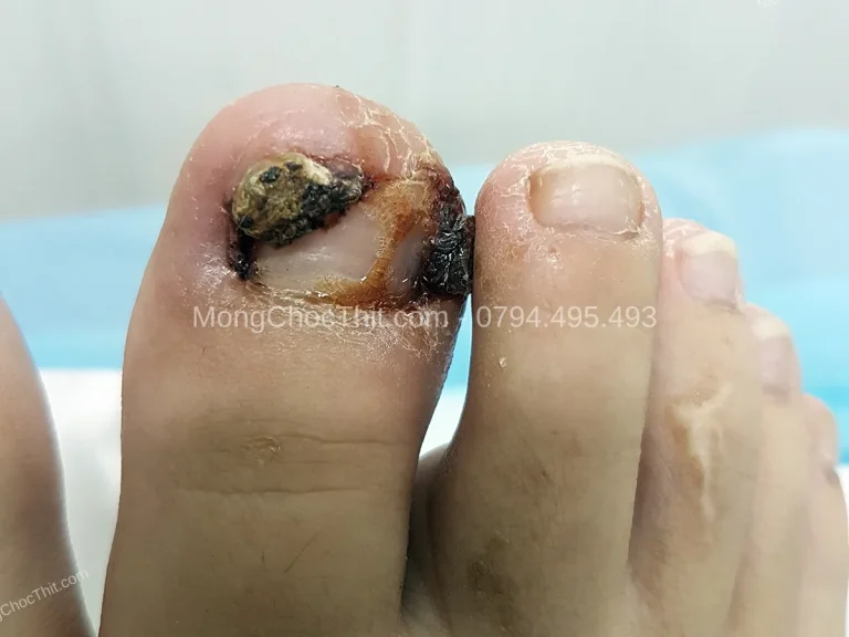 Chọn giày dép phòng tái phát móng quặm sau tiểu phẫu