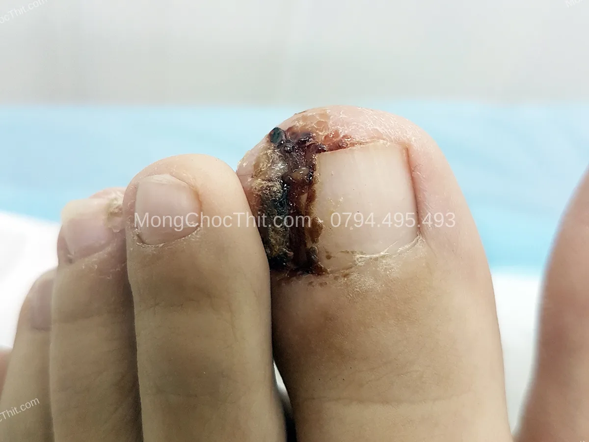 tiểu đường sau tiểu phẫu