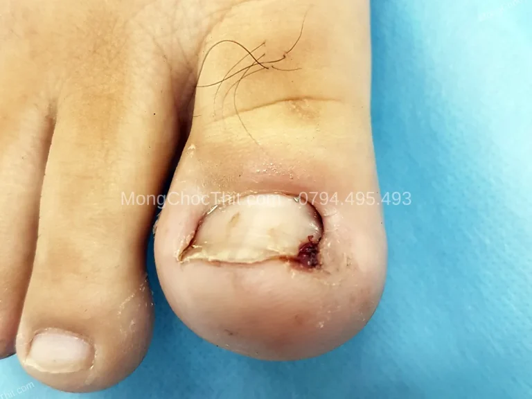 Người tiểu đường sau tiểu phẫu móng: Kiểm soát đường huyết và lành thương