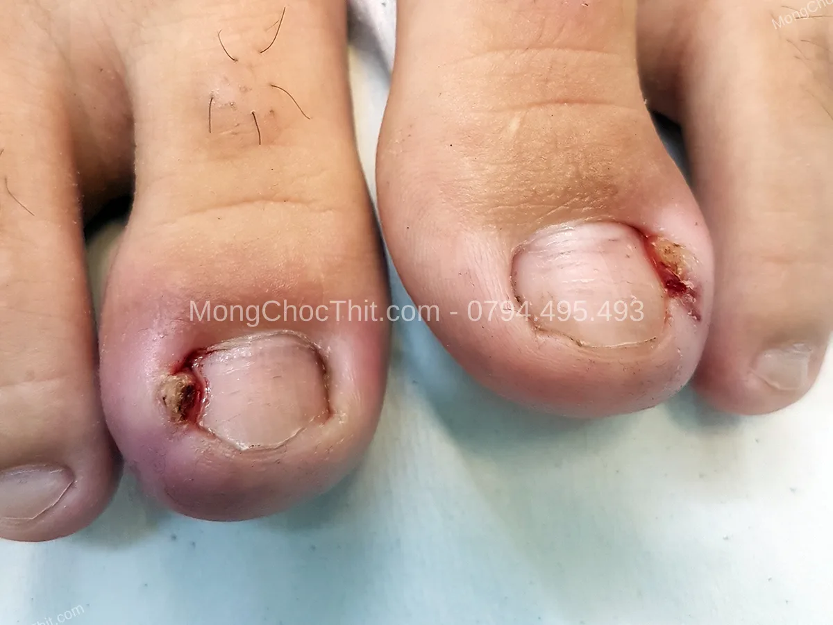 người gi&agrave; sau tiểu phẫu