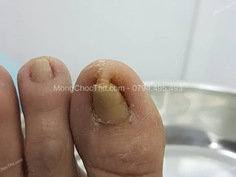 Cắt móng đúng cách sau tiểu phẫu: Kỹ thuật để không tái phát