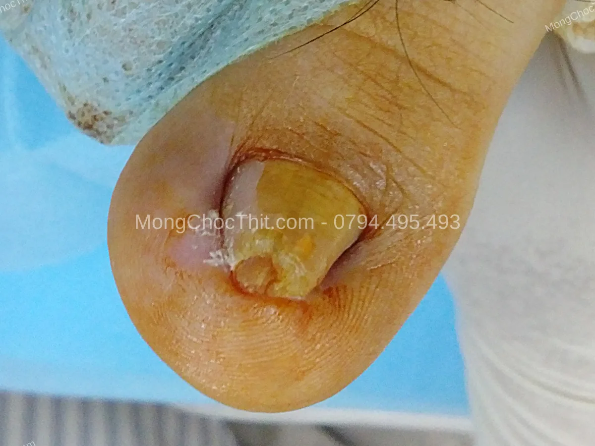 l&agrave;m việc sau tiểu phẫu