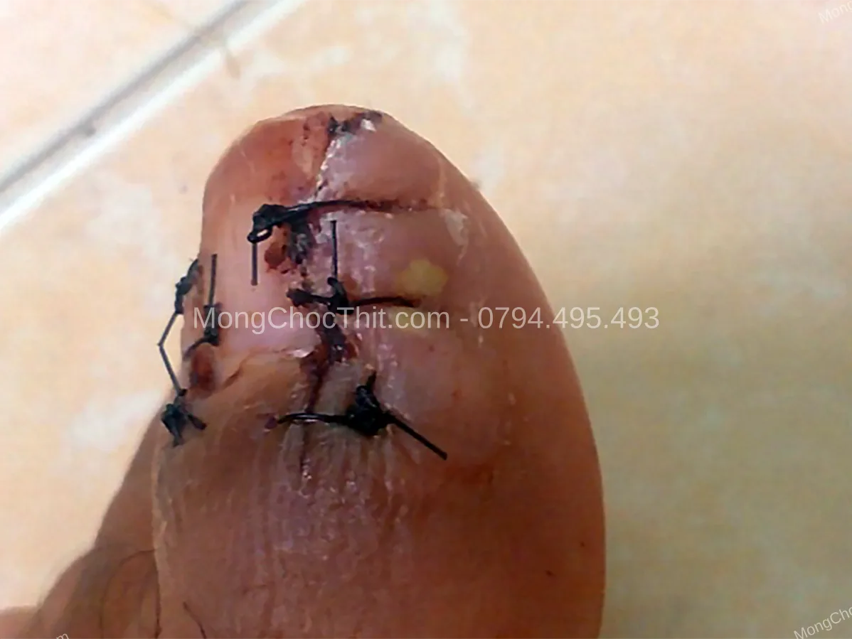 nhiễm tr&ugrave;ng sau tiểu phẫu