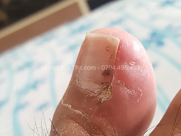 Kiêng ăn gì sau tiểu phẫu móng chọc thịt?