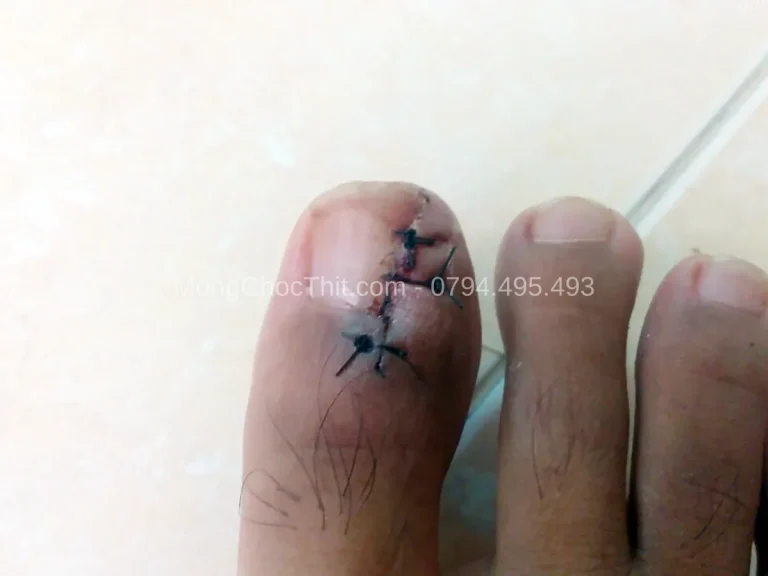 Vết thương lâu lành sau tiểu phẫu móng: Nguyên nhân và cách xử lý