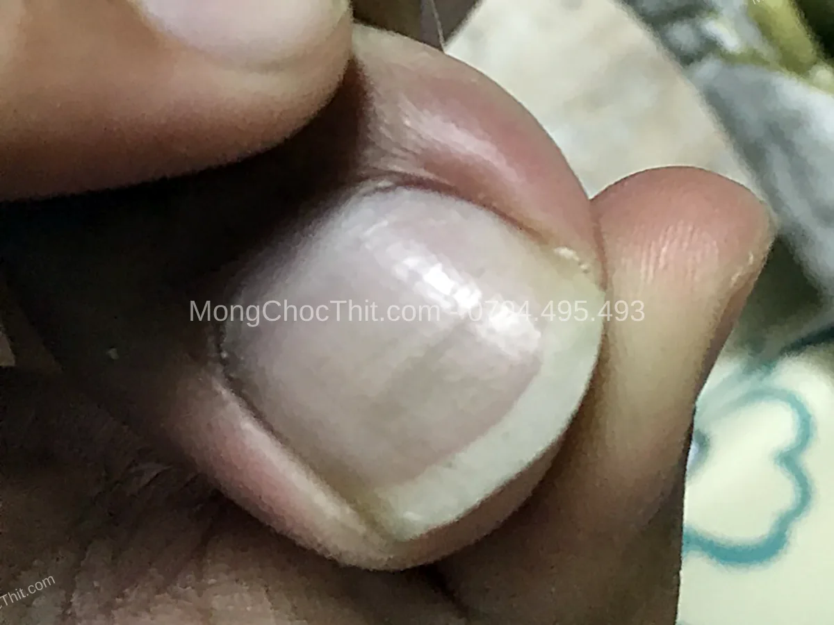 l&agrave;nh vết thương tiểu phẫu