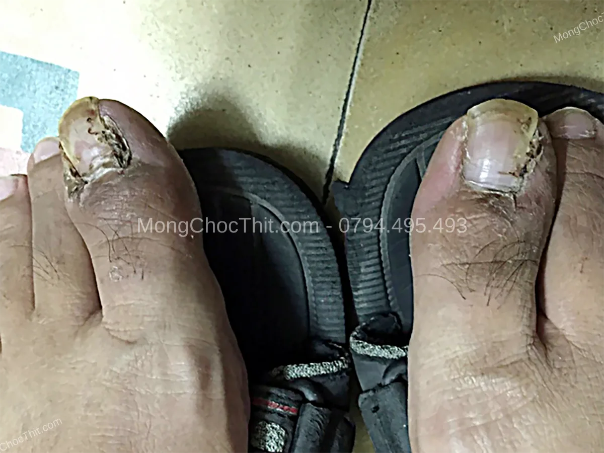 rượu bia sau tiểu phẫu