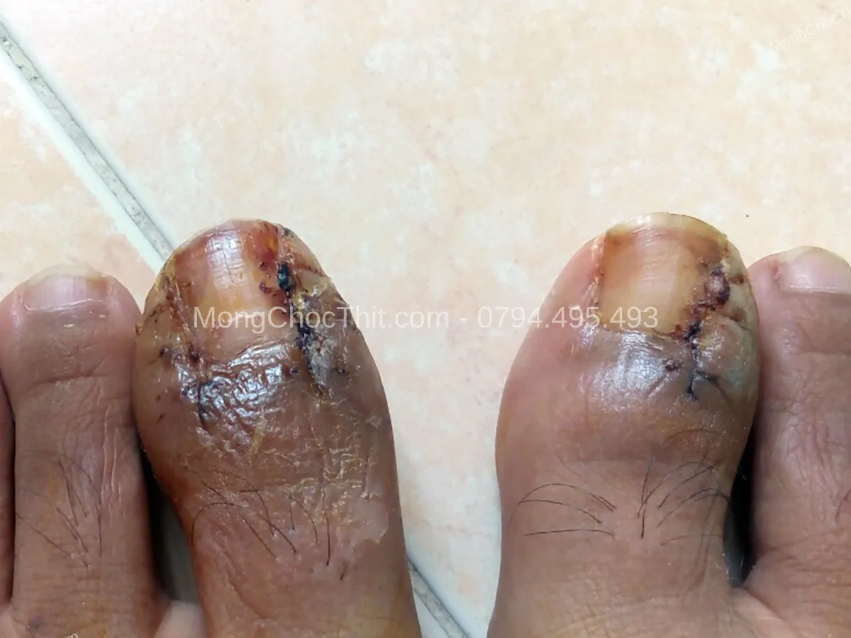 cảm gi&aacute;c sau tiểu phẫu