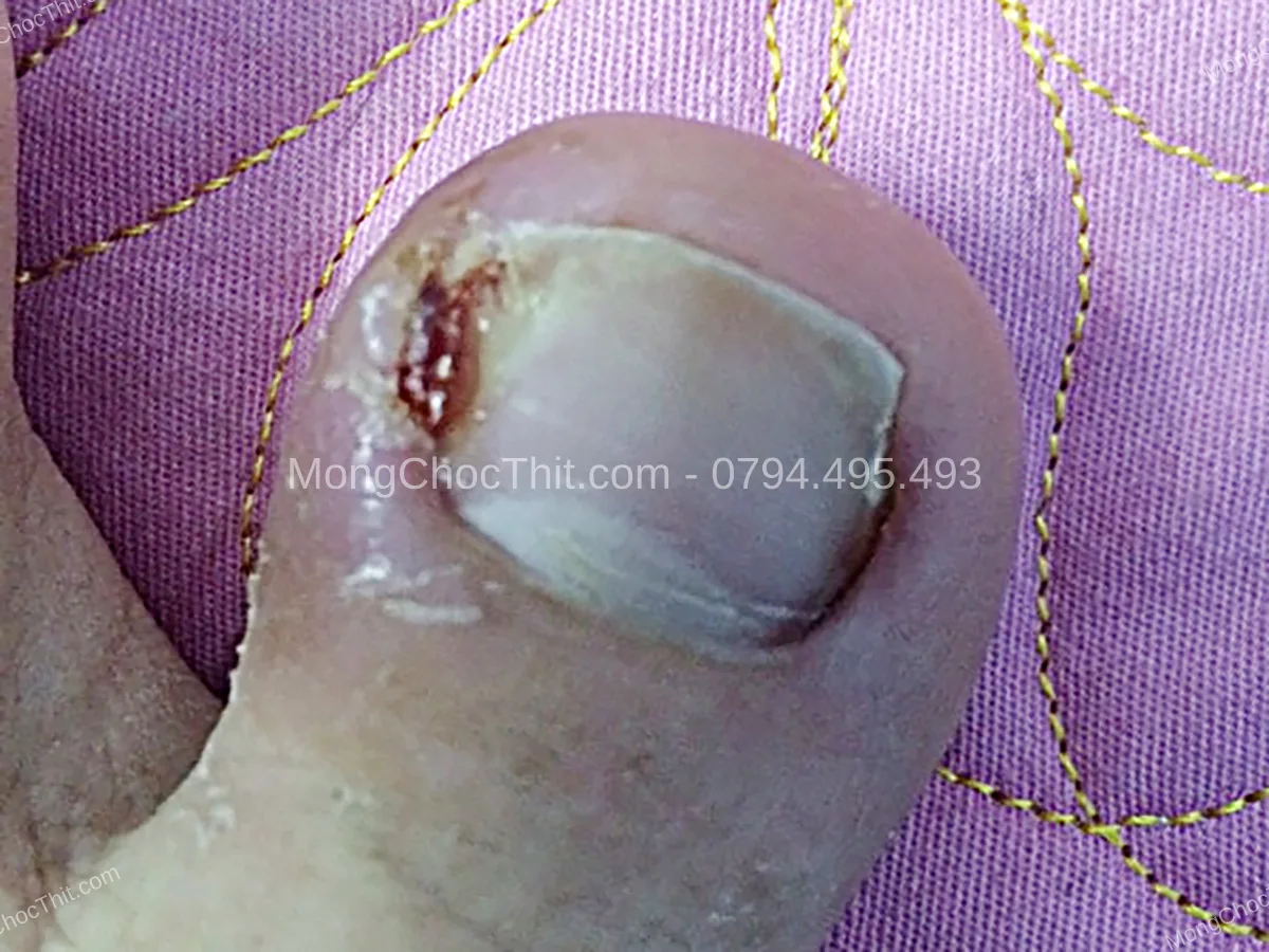 ki&ecirc;ng ăn sau tiểu phẫu