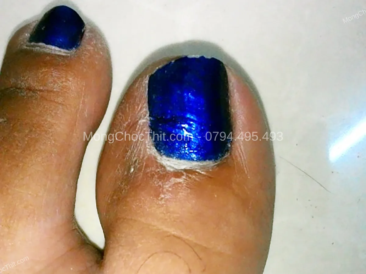 vết thương l&acirc;u l&agrave;nh