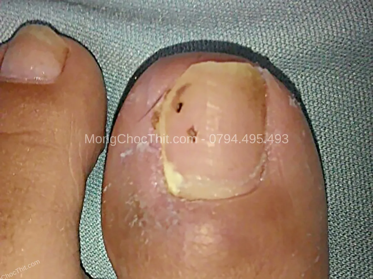 ăn uống sau tiểu phẫu