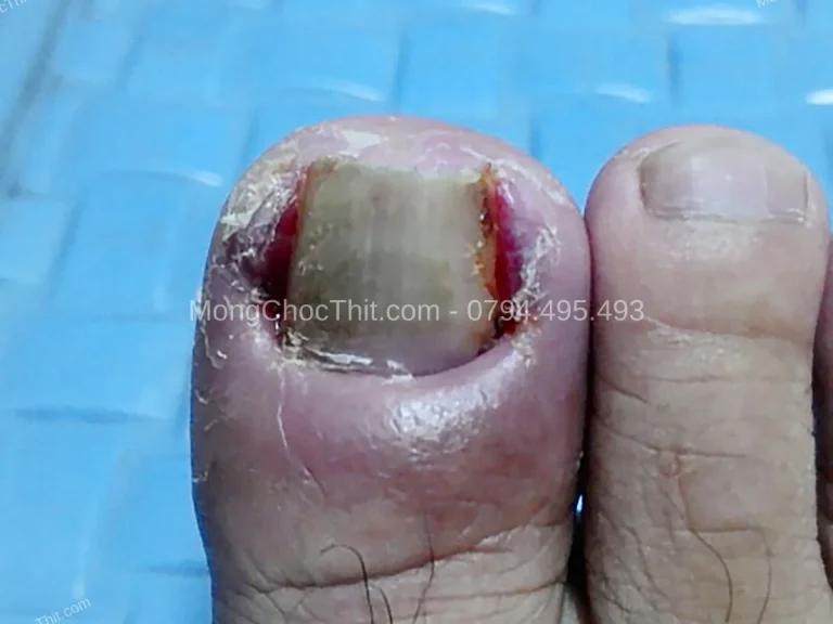 Chế độ ăn uống giúp lành vết thương nhanh sau tiểu phẫu móng