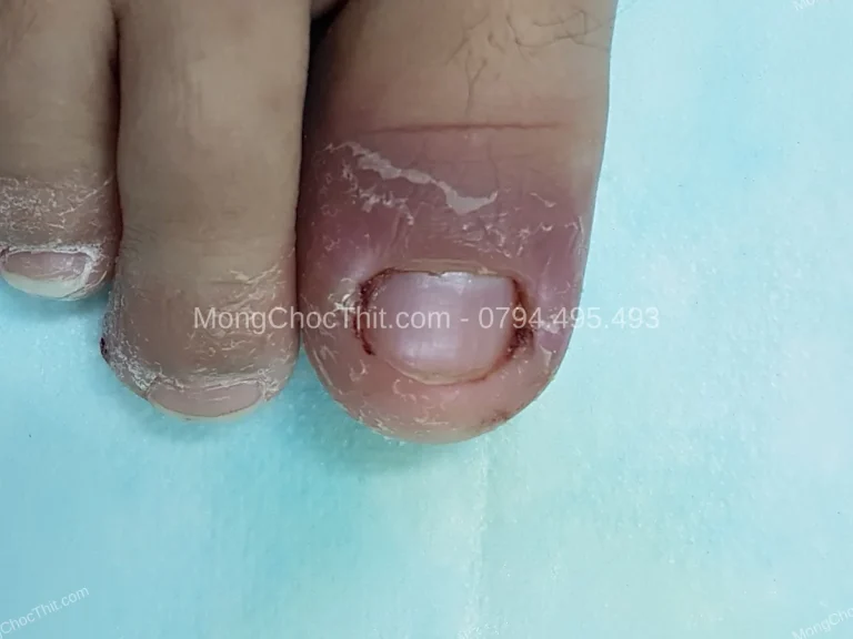 Mổ móng chọc thịt 2 ngón cùng lúc: ca 4 khoé của bệnh nhân người Mỹ