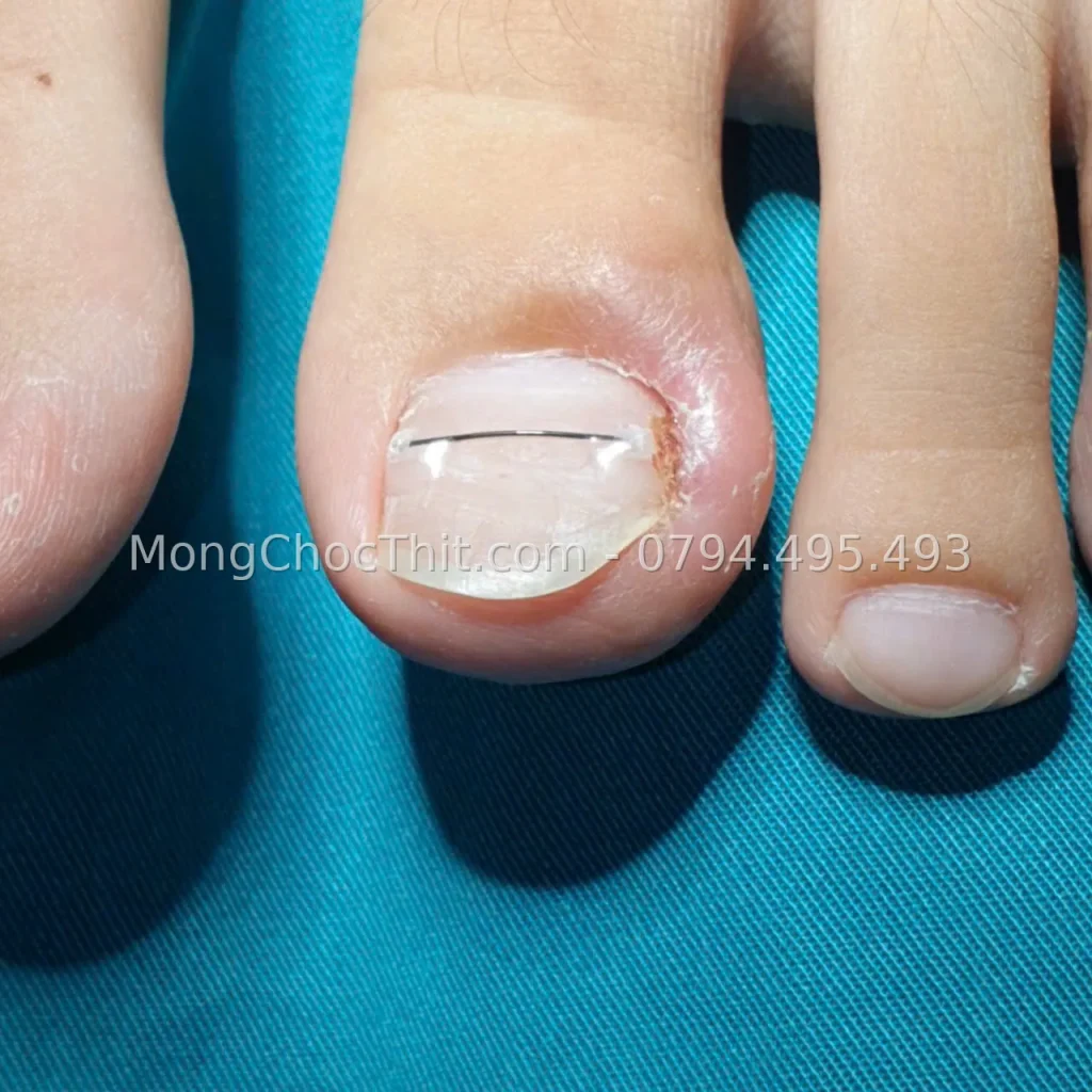 Niềng móng chân – hình 2