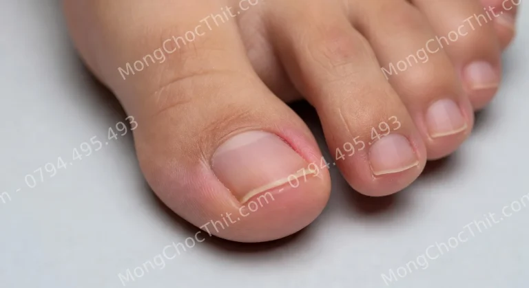 Tự cắt khoé móng chân ở nhà bị chảy máu, viêm hơn một tháng không khỏi