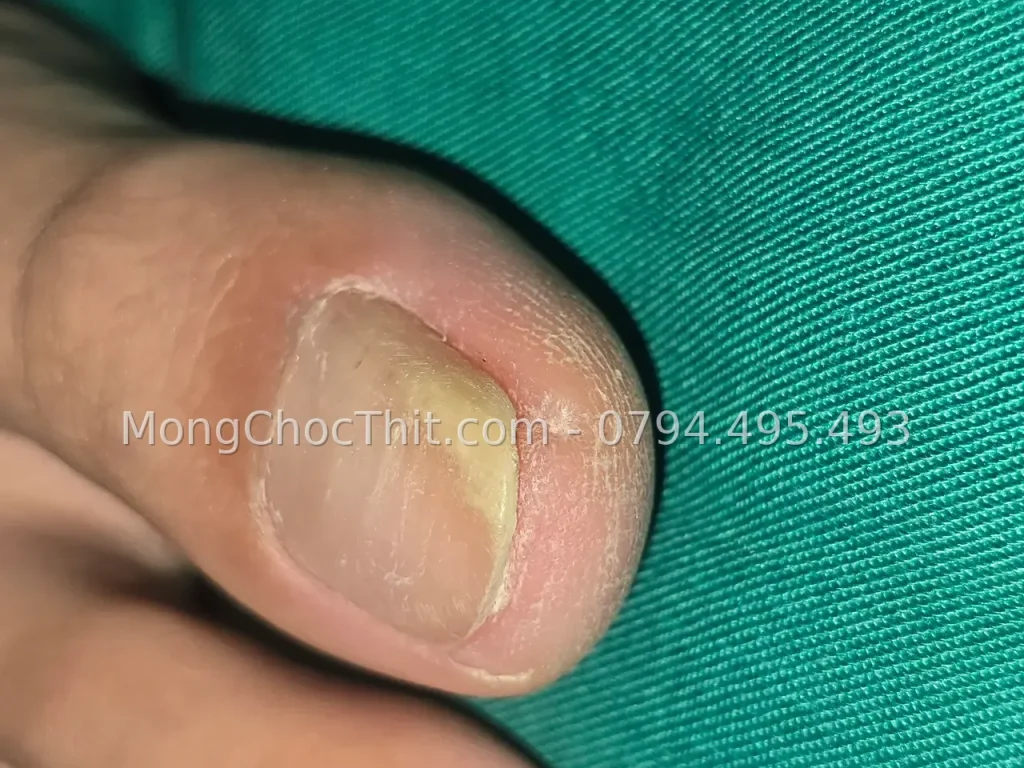 Mổ móng chọc thịt bị tái phát – hình 2