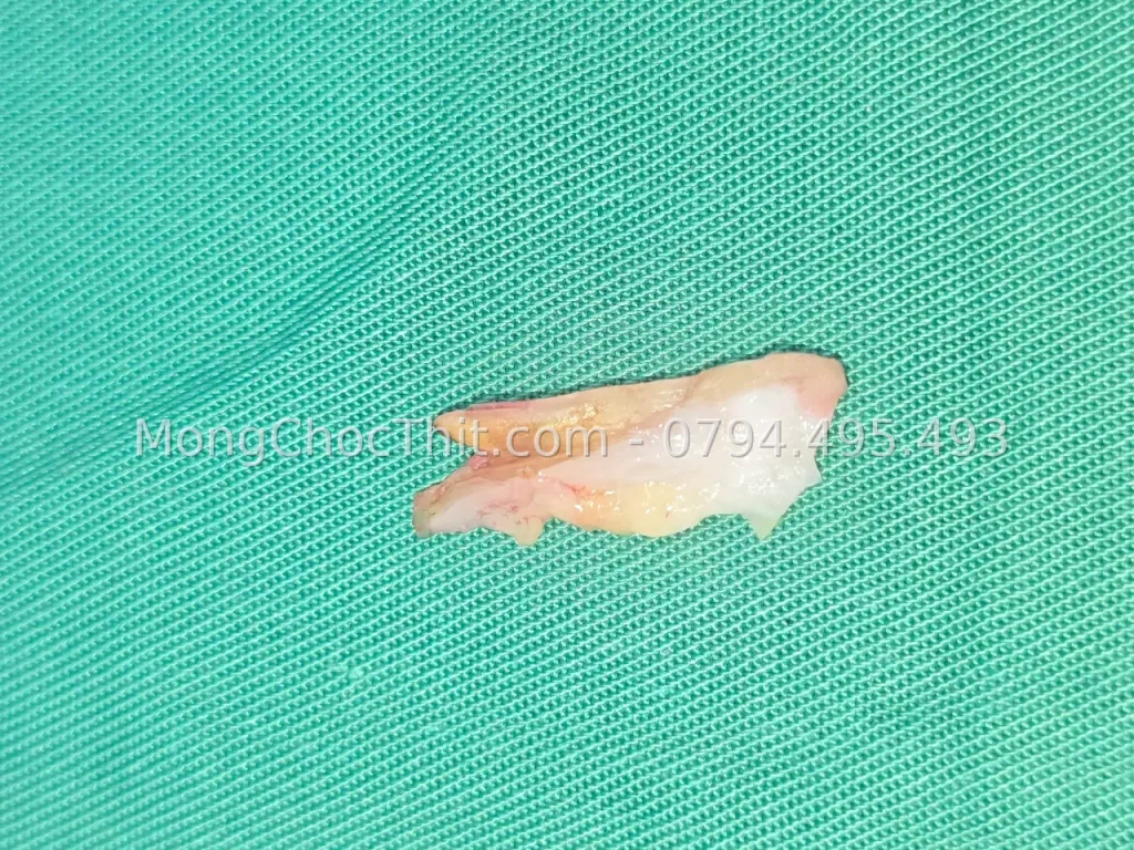 Mổ móng chọc thịt bị tái phát – hình 3