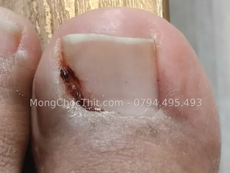 Móng chọc thịt một khoé ngón cái: tiểu phẫu gọn trong một buổi