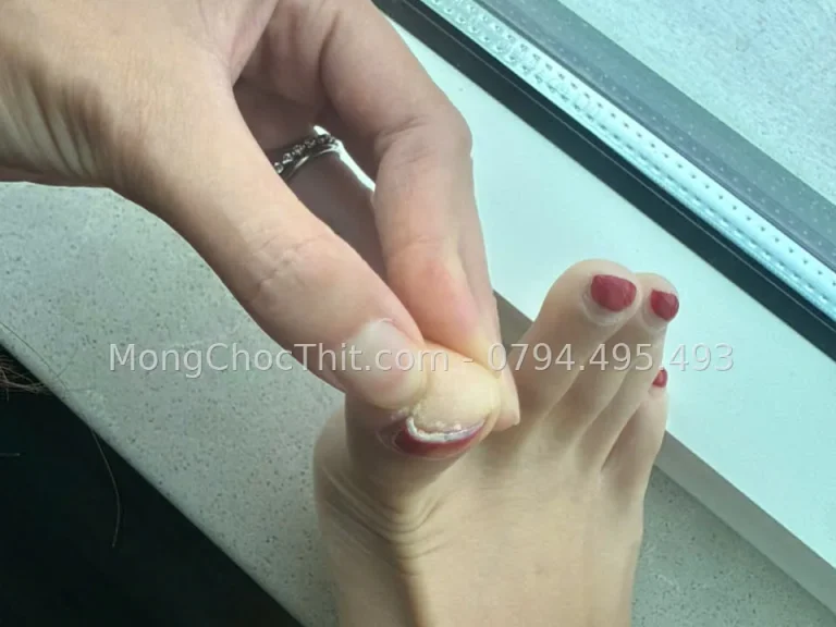 Mổ móng chọc thịt bị tái phát: ca Việt kiều Thụy Điển mổ lại tại TP.HCM
