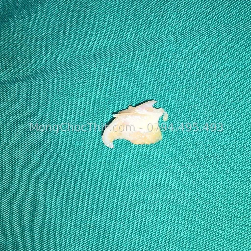 Móng chọc thịt chân còn lại